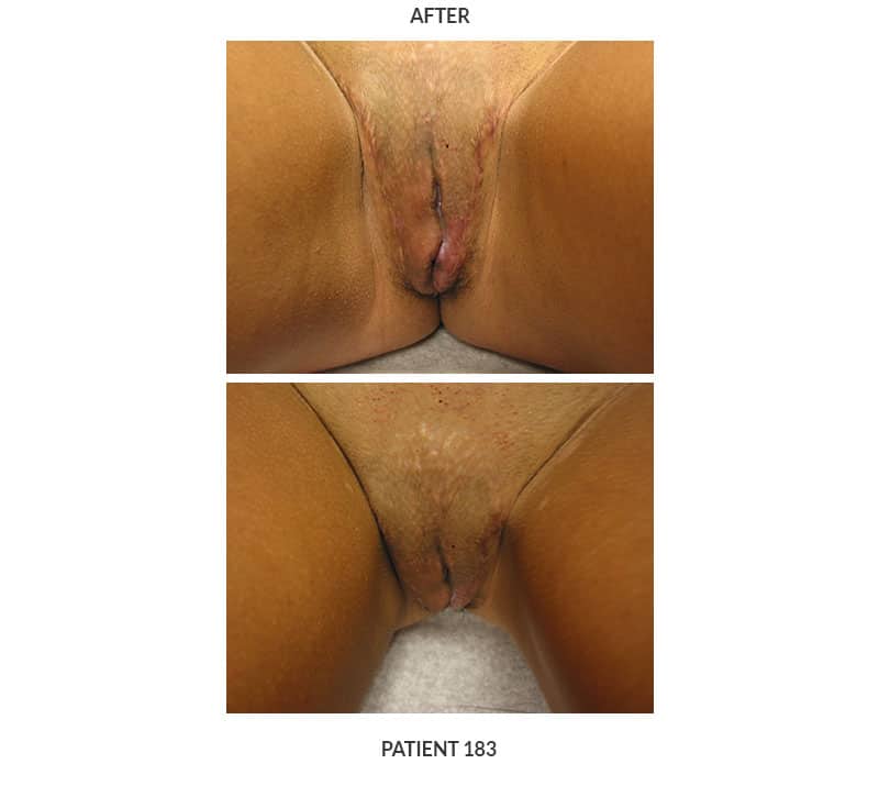 this image shows post surgical images from a gender confirming full vaginoplasty performed by Dr. Keelee MacPhee