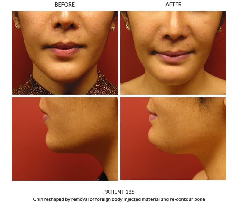 Post operative photos of facial feminization procedures, specifically chin resharping, performed by Dr. Keelee Macphee
