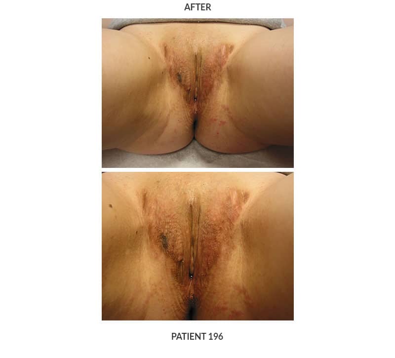 this image shows post surgical images from a gender confirming full vaginoplasty performed by Dr. Keelee MacPhee