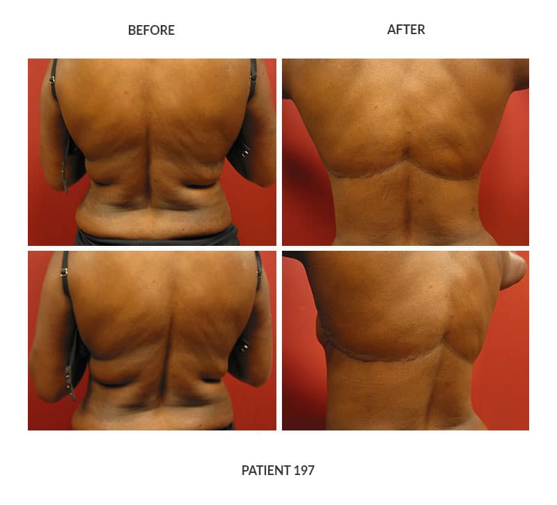 A body contouring procedure completed by Dr. Keelee MacPhee shows a bra line lift.