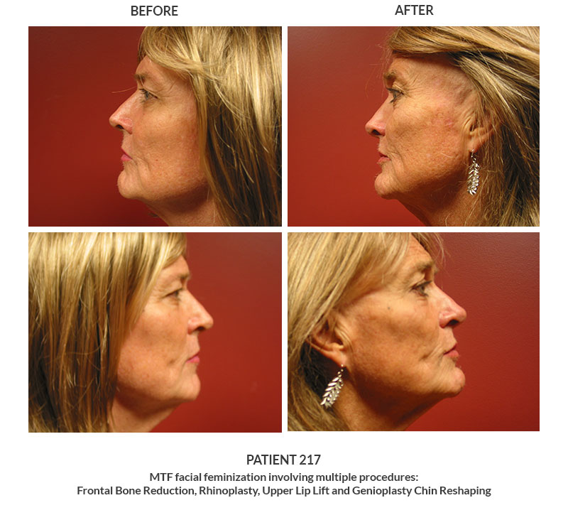 217 MTF Facial Feminization Forehead Contouring