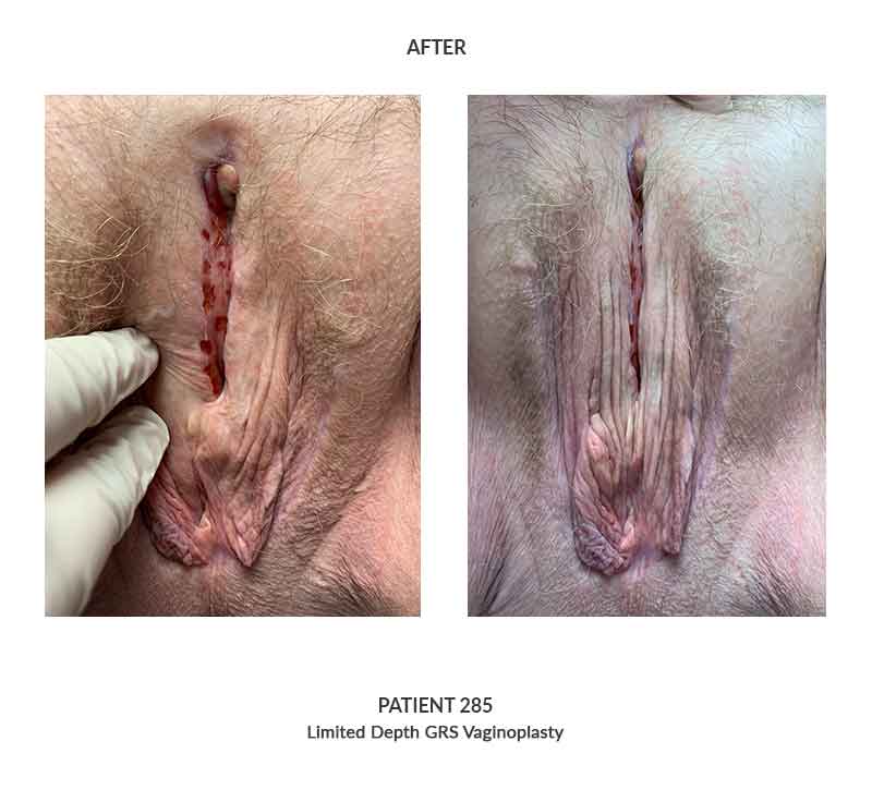 this image shows post surgical images from a limited depth vaginoplasty performed by Dr. Keelee MacPhee