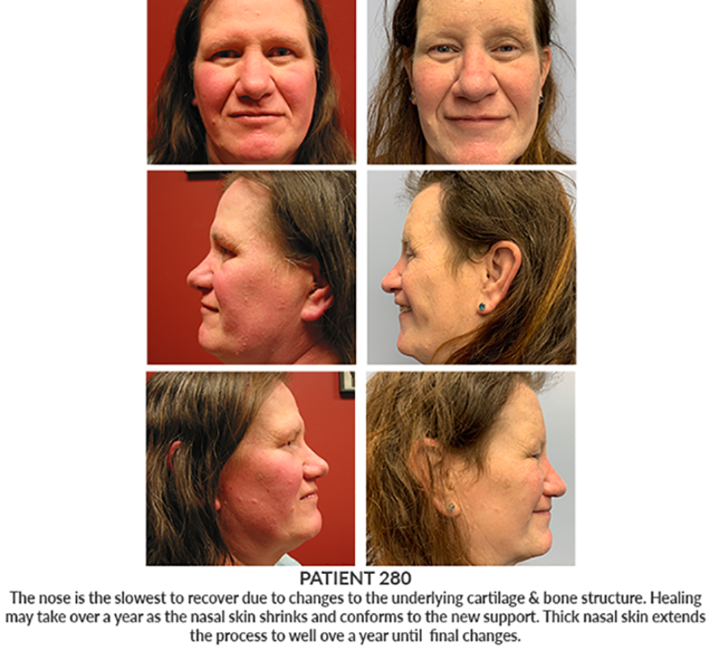 Post operative photos of facial feminization procedures performed by Dr. Keelee Macphee