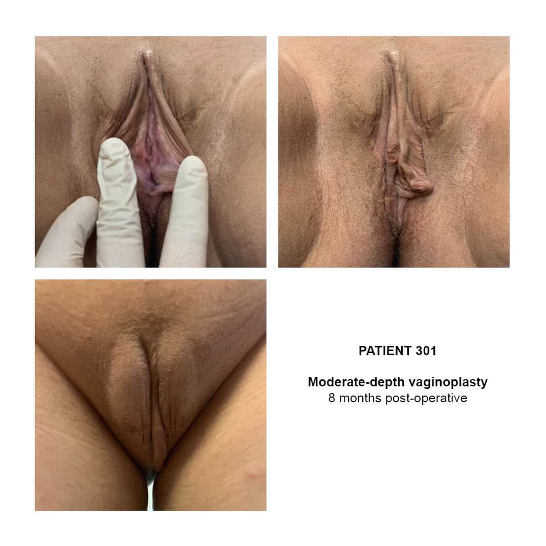 301_mod-depth-vaginoplasty