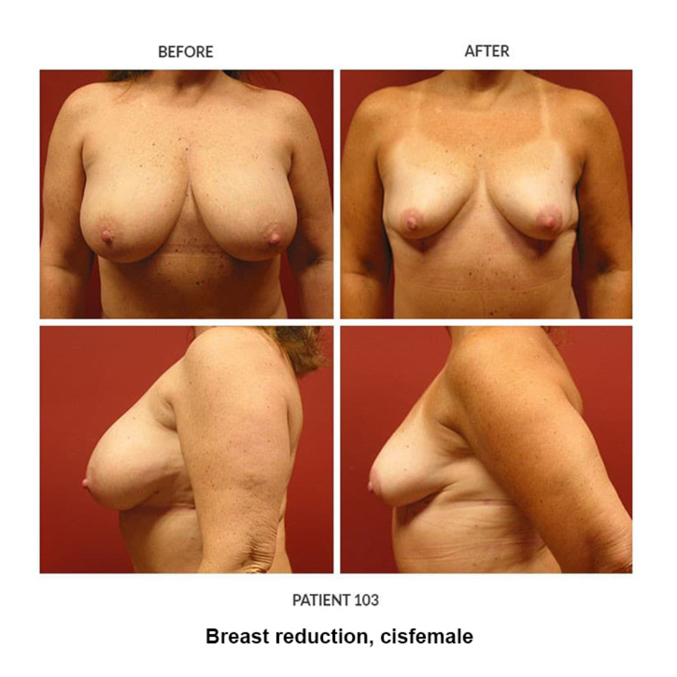 103_Breast-reduction-cisfemale