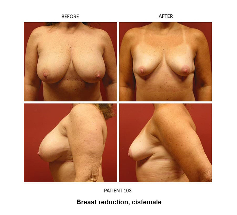 103_Breast-reduction-cisfemale