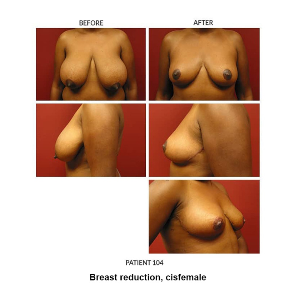 104_Breast-reduction-cisfemale