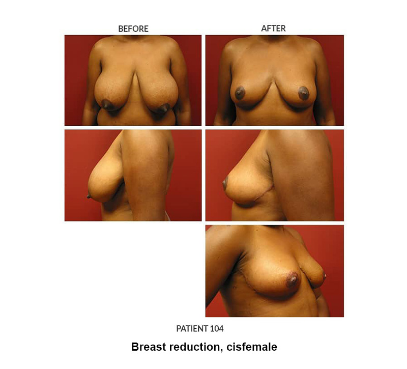 104_Breast-reduction-cisfemale