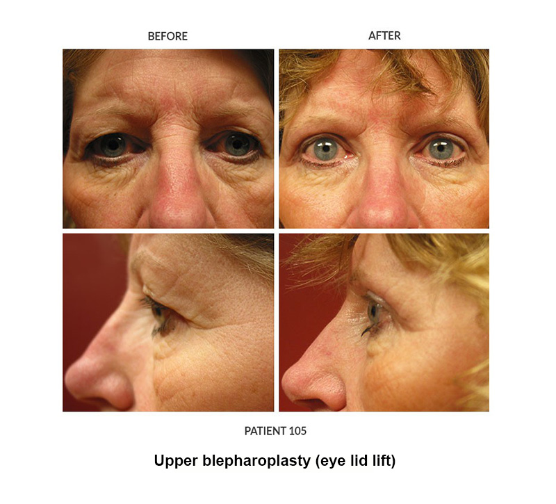 Post operative photos of an eye lid lift, or blepharoplasty, performed by Dr. Keelee Macphee