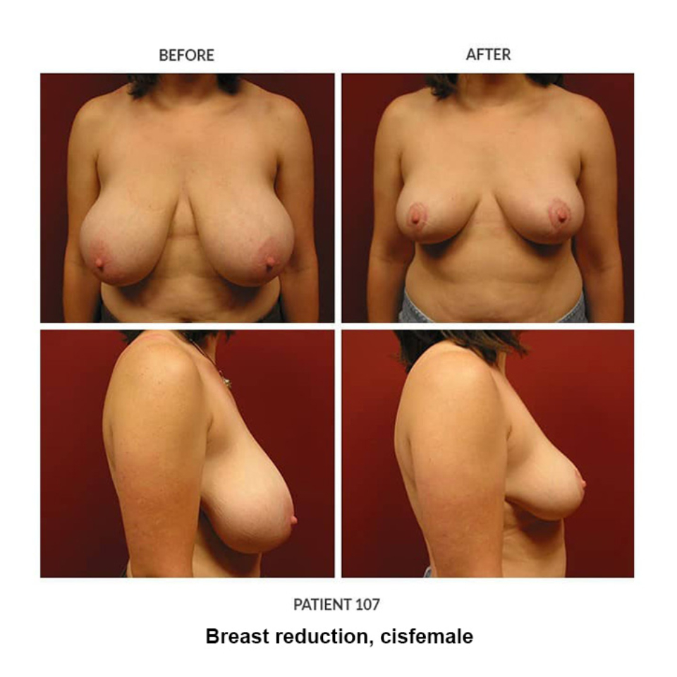 107_Breast-reduction-cisfemale