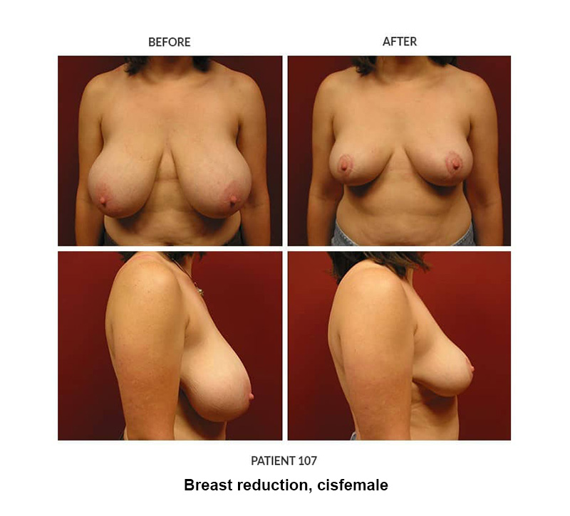 107_Breast-reduction-cisfemale