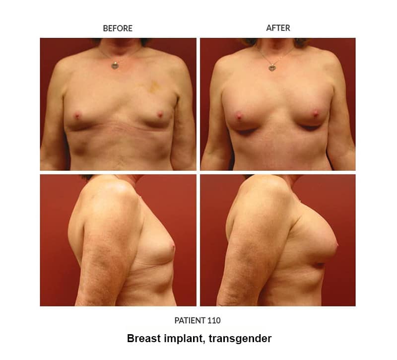 110_Breast-implant_trans