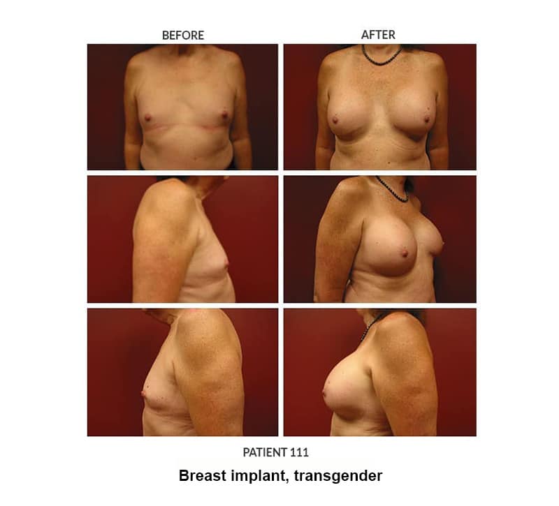 111_Breast-implant_trans