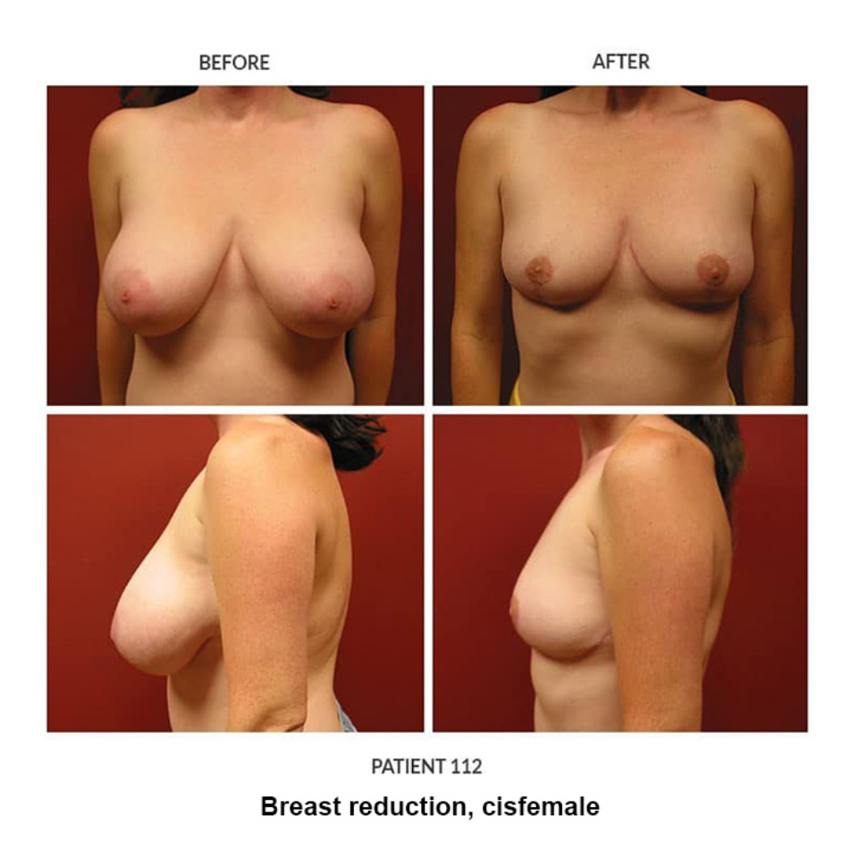 112_Breast-reduction-cisfemale