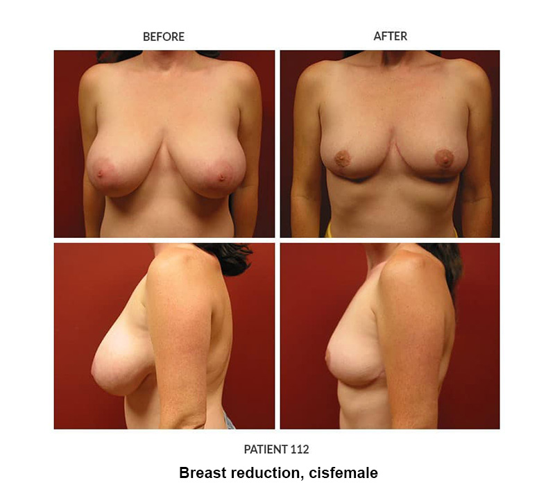 112_Breast-reduction-cisfemale