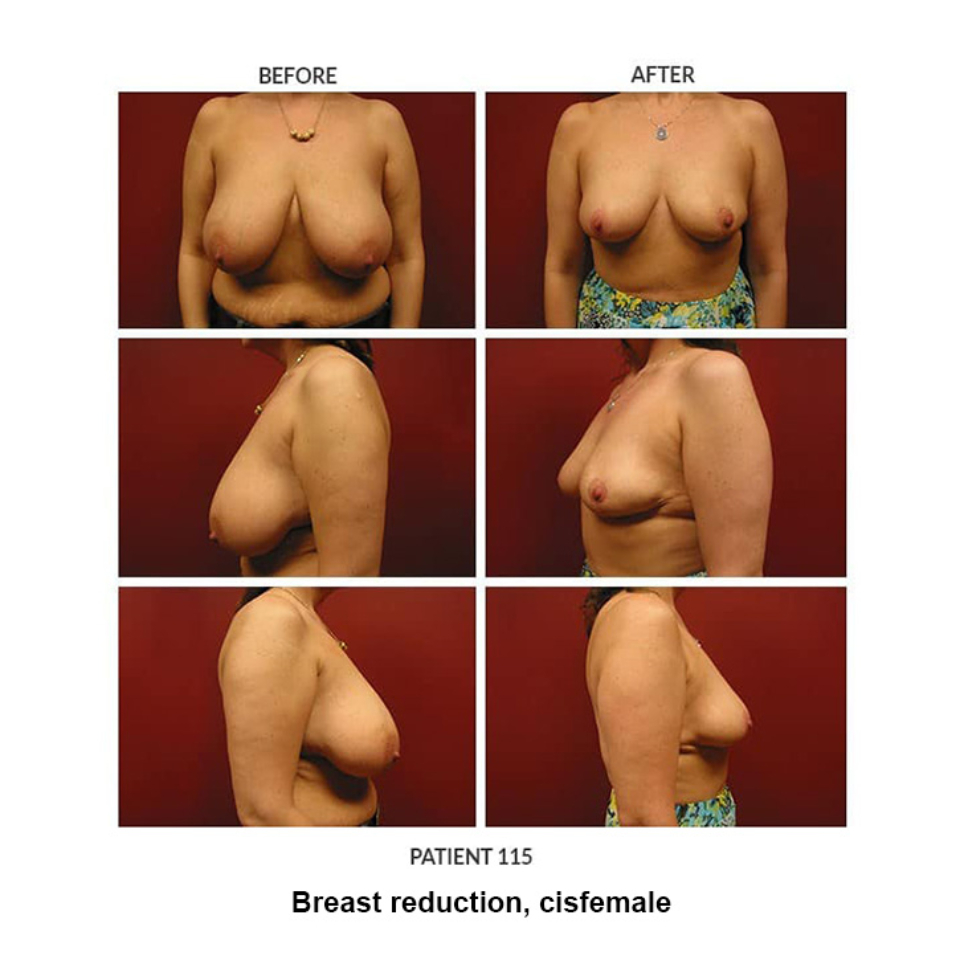 115_Breast-reduction-cisfemale