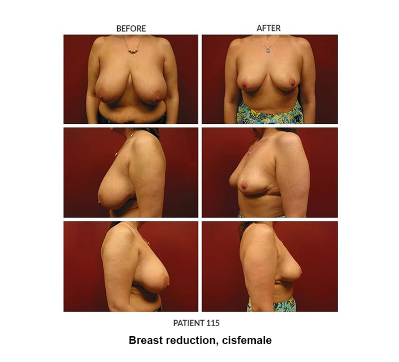 115_Breast-reduction-cisfemale