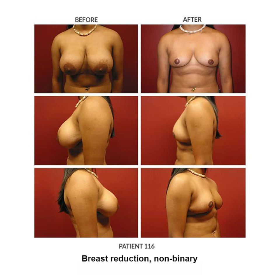 116_Breast-reduction,-non-binary