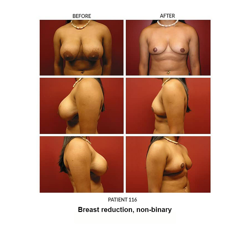 116_Breast-reduction,-non-binary