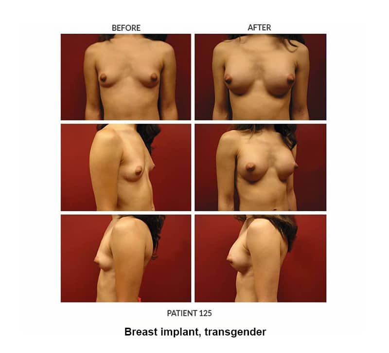 125_Breast-implant_trans