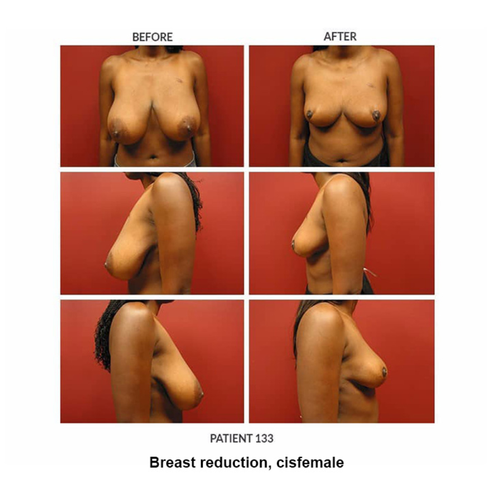 133_Breast-reduction-cisfemale