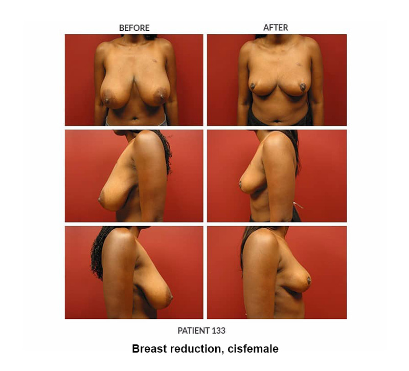 133_Breast-reduction-cisfemale