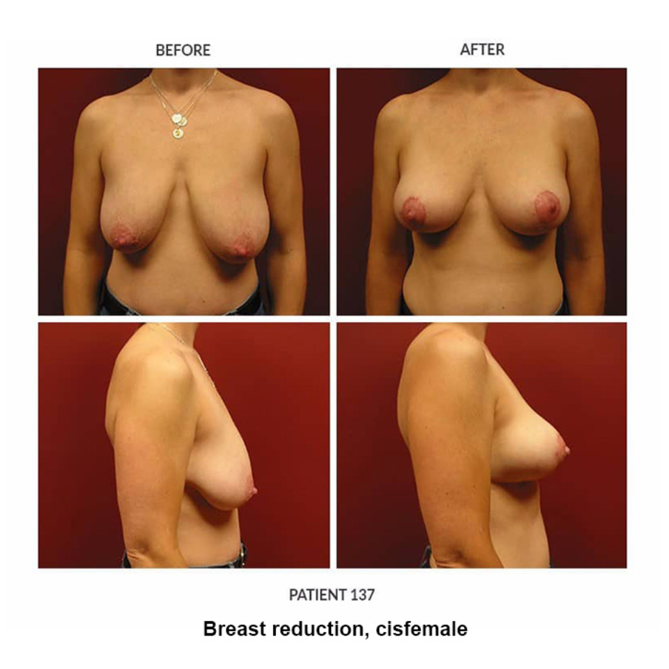 137_Breast-reduction-cisfemale