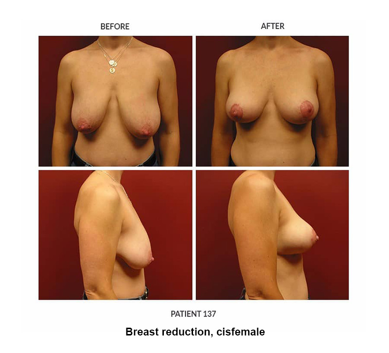 137_Breast-reduction-cisfemale
