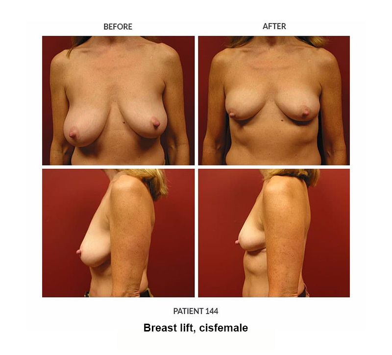 144_Breast-lift-cisfemale