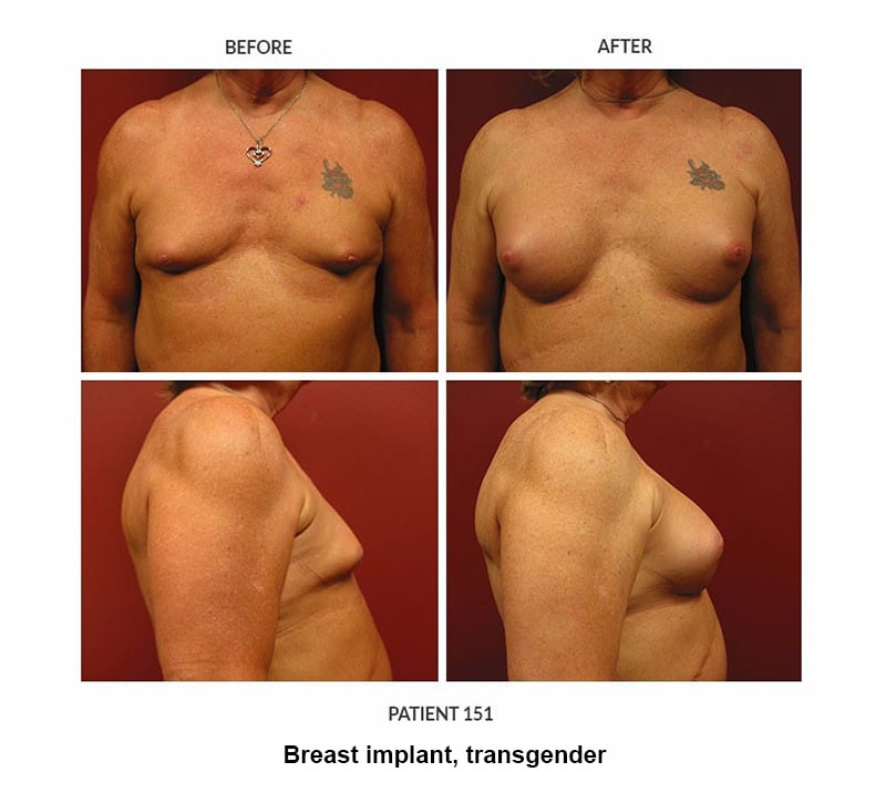 151_Breast-implant_trans