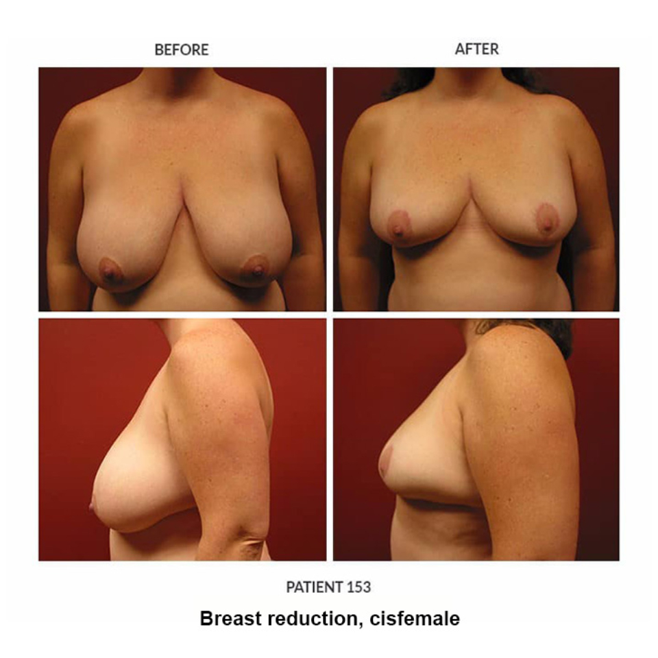 153_Breast-reduction-cisfemale