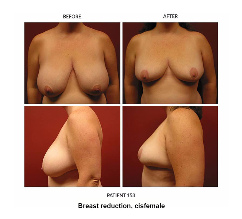 153_Breast-reduction-cisfemale
