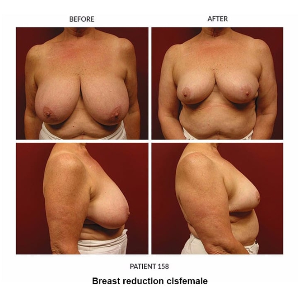 breast reduction cis female