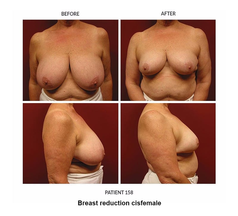 breast reduction cis female