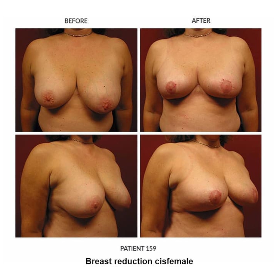 before and after photos breast reduction cisgender female