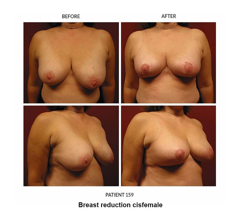 before and after photos breast reduction cisgender female