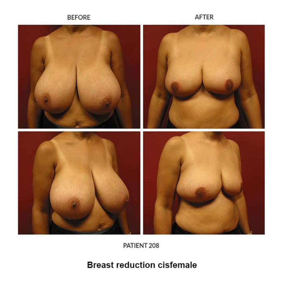 before and after photos of breast reduction