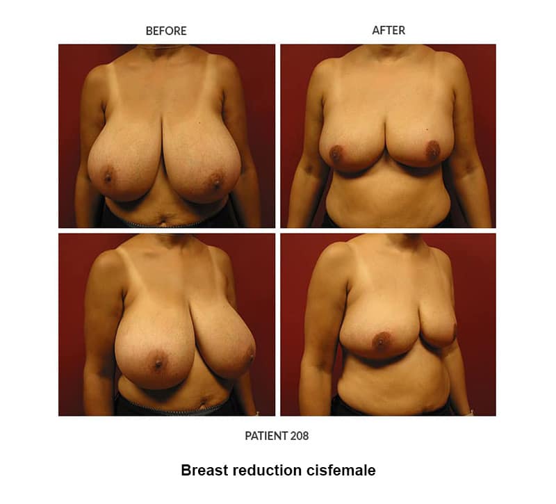 before and after photos of breast reduction