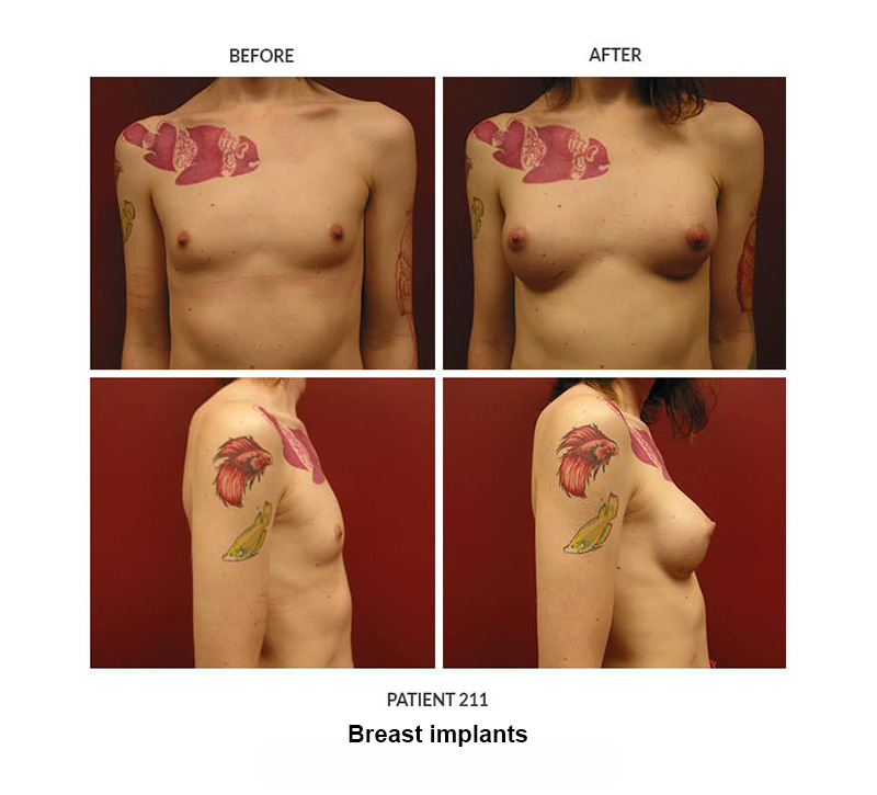 211_Breast-implants