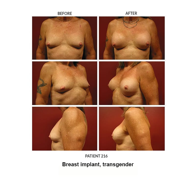 216_Breast-implant_trans