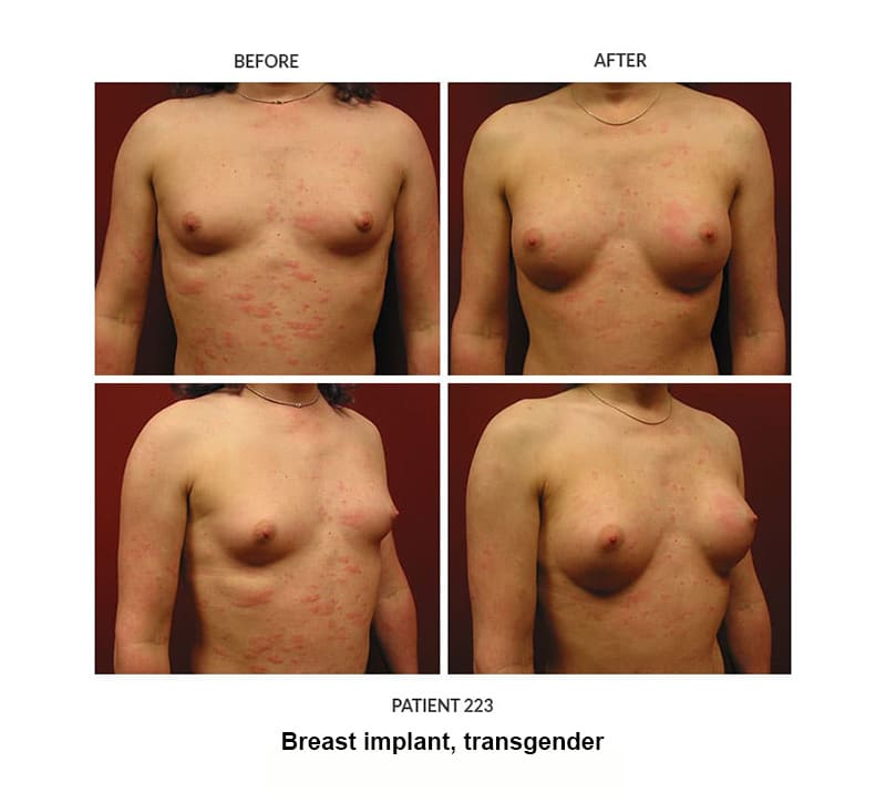 223_Breast-implant_trans