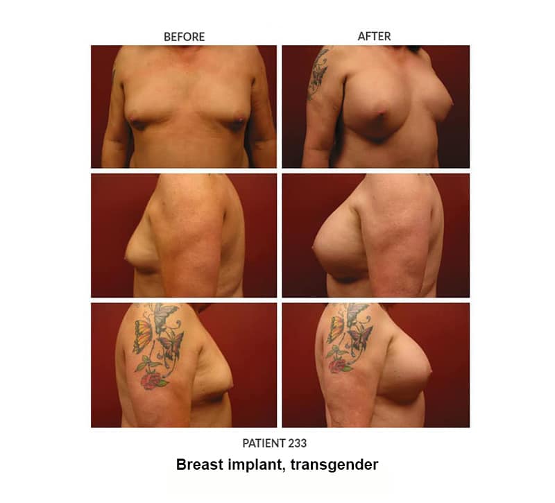 233_Breast-implant_trans