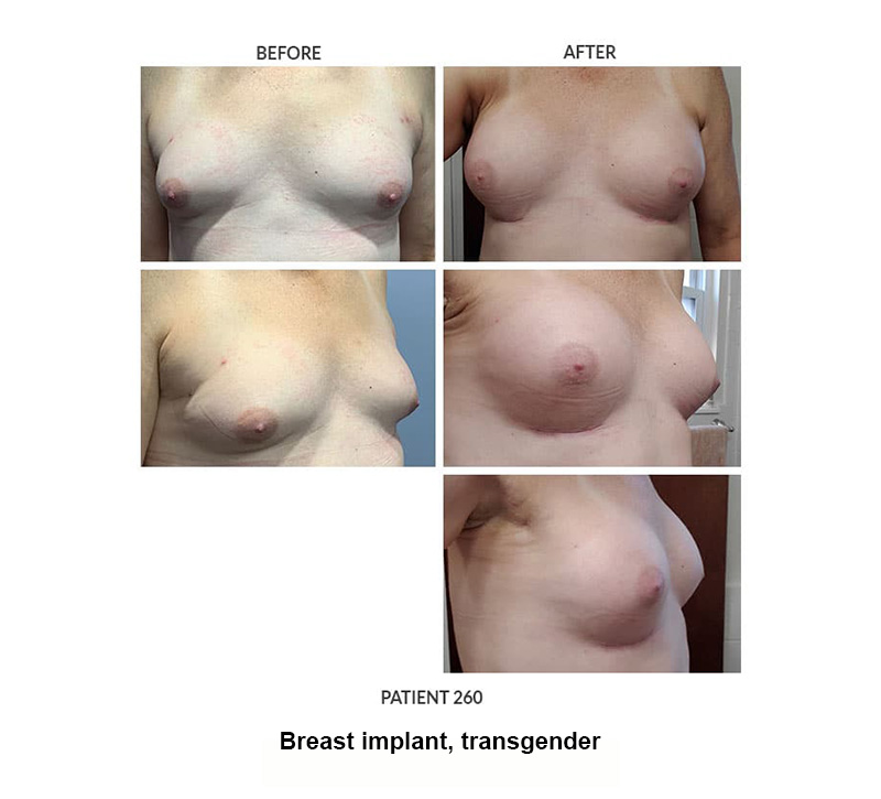 260_Breast-implant_trans