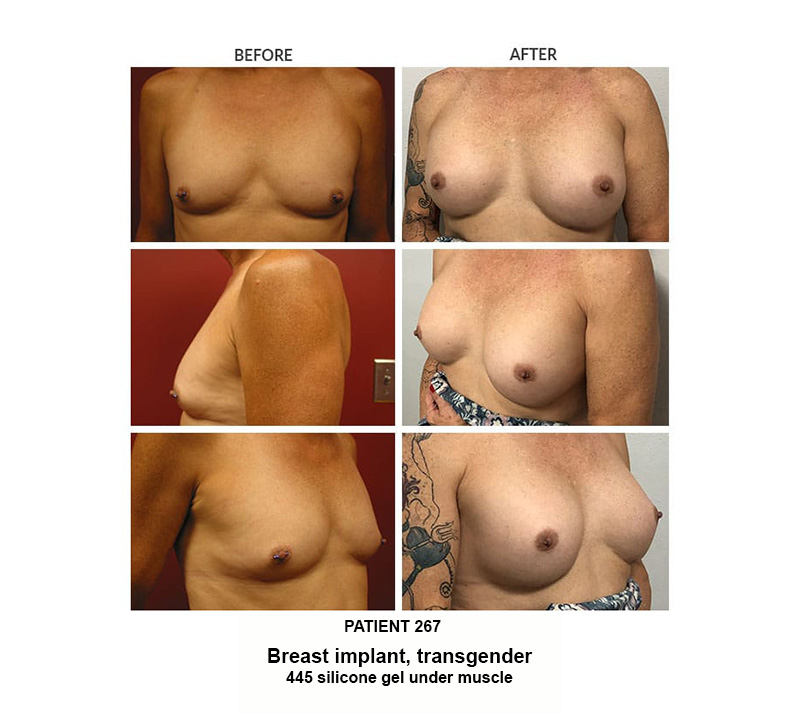 267_Breast-implant_trans