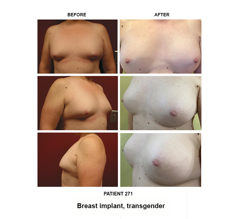 271_Breast-implant_trans