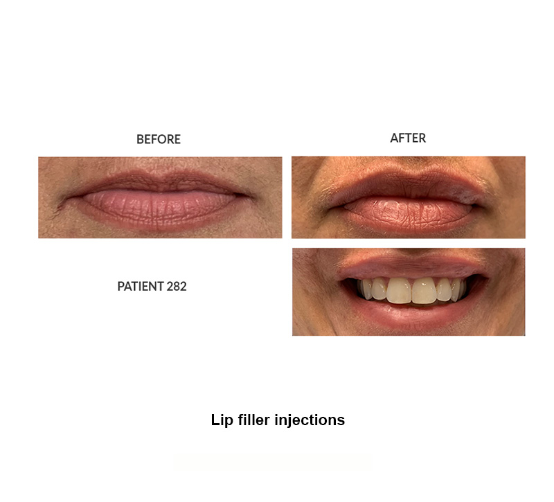 282_Lip-filler-injections