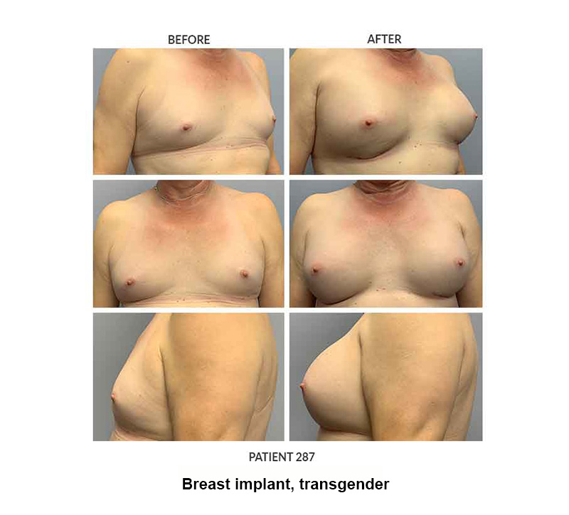 287_Breast-implant_trans