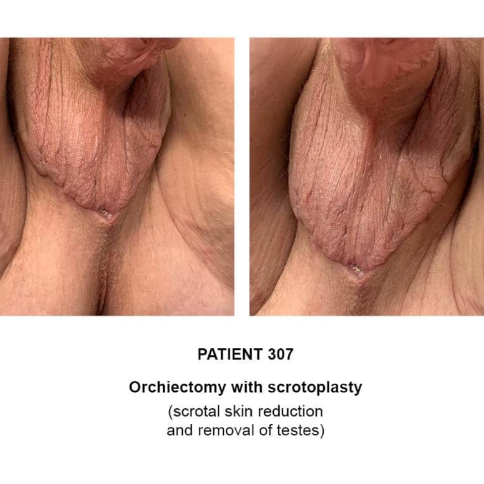 scrotoplasty orchiectomy procedure