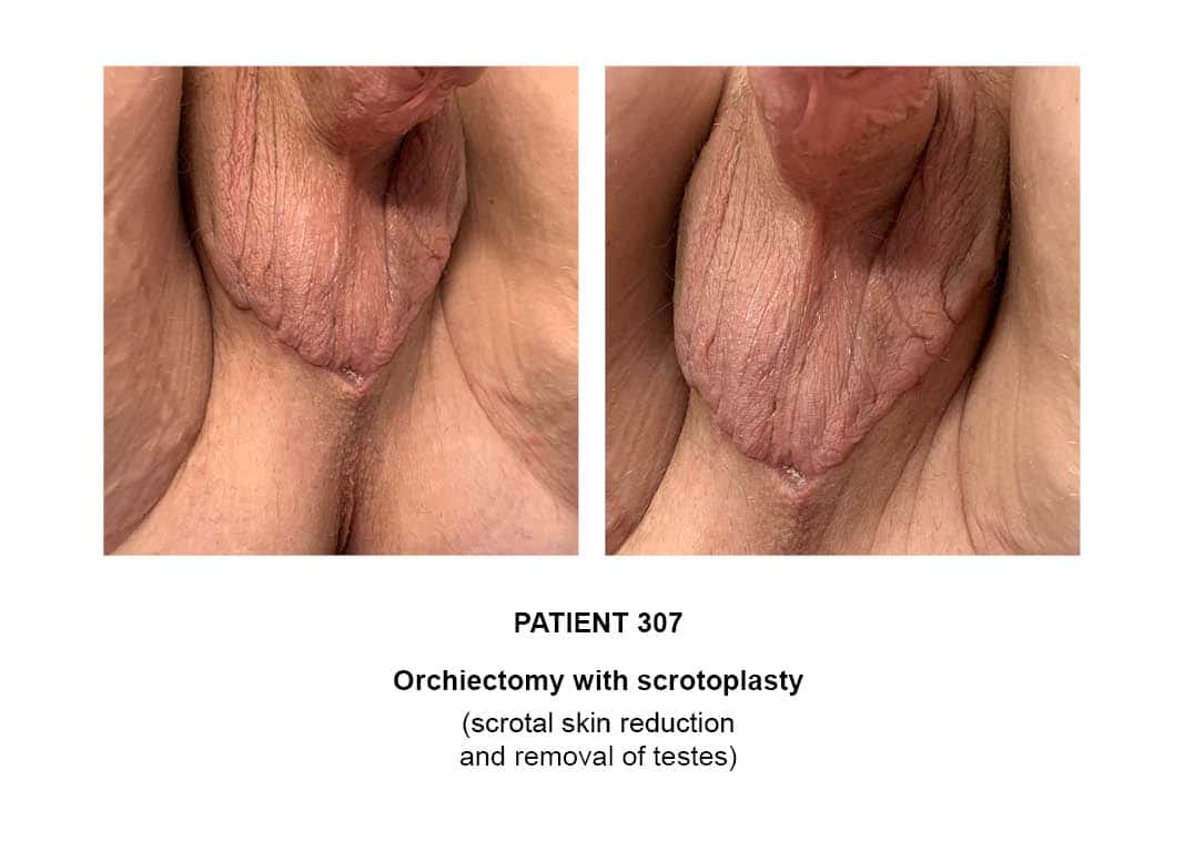 scrotoplasty orchiectomy procedure