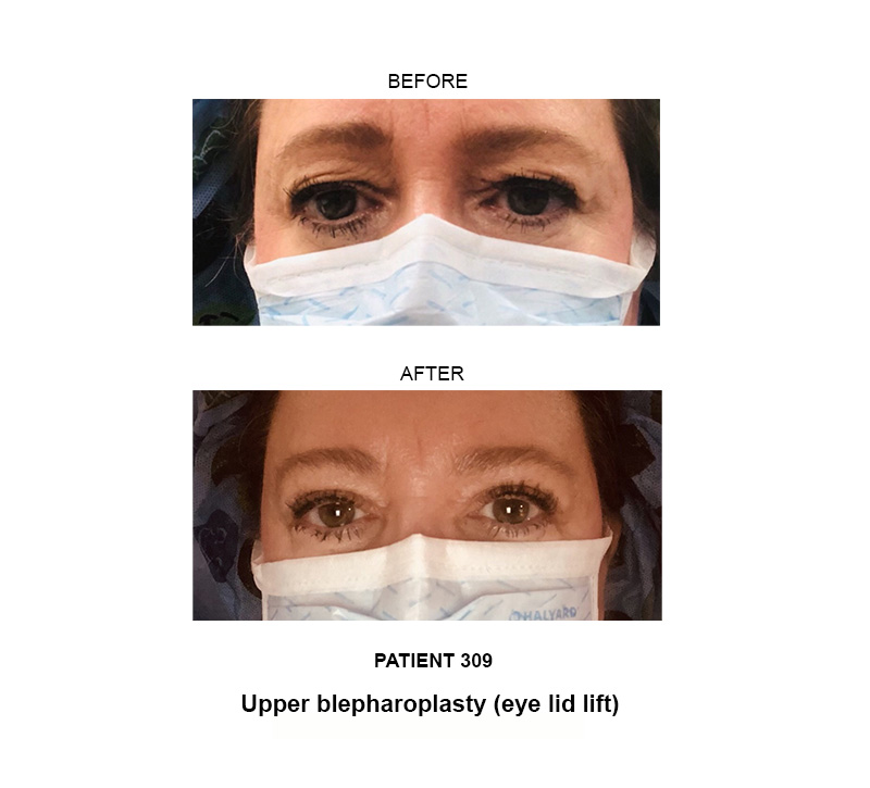 Upper blepharoplasty before and after photos